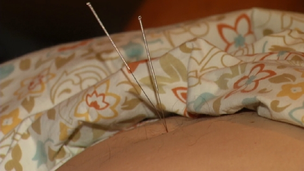 Acupuncture for sciatic nerve pain KFOX