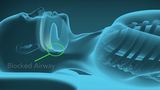 Implanted sleep apnea device promises safer, uninterrupted sleep, doctors say